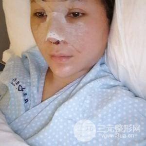 进口假体+肋软骨垫鼻尖三个月果恢复对比图