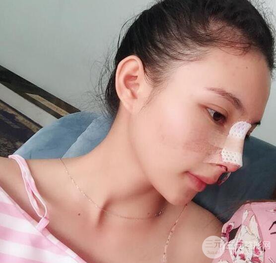 妹子做了隆鼻整形后竟变混血脸，来看看像baby还是娜扎