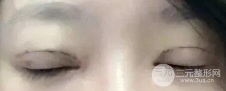 双眼皮手术后恢复期记录