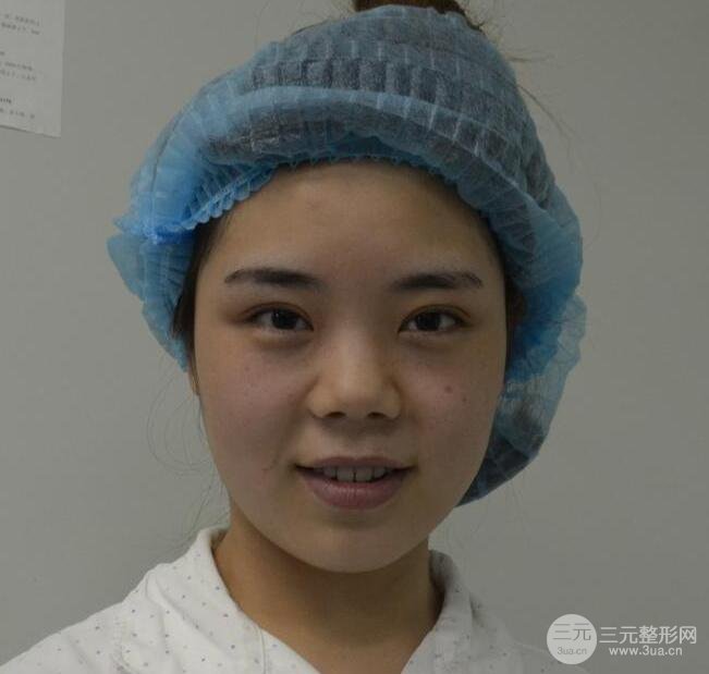 肋软骨隆鼻整形九十天恢复记录