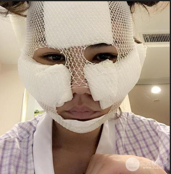 泉州亿星闵英俊磨骨恢复图分享