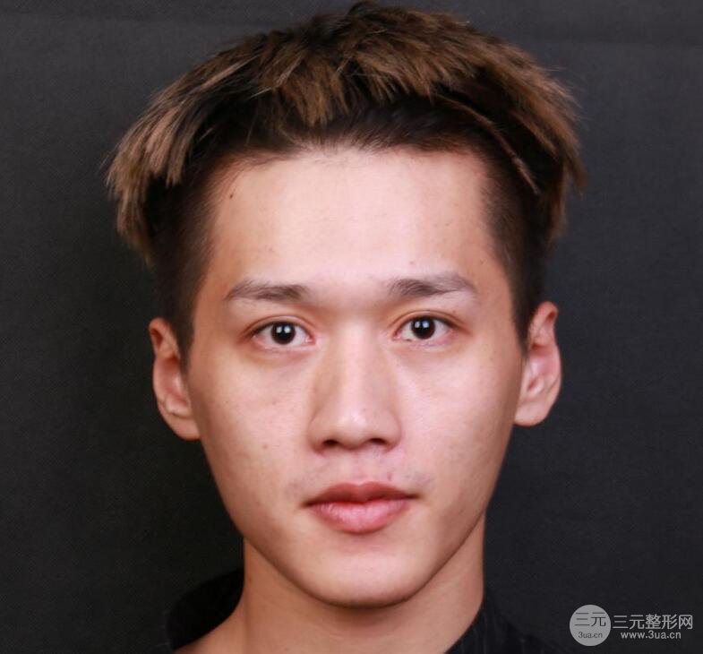 男生隆鼻整形真人恢复记录一览