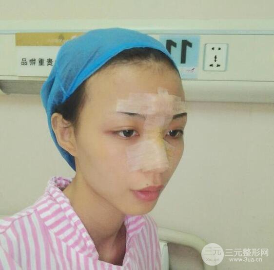 凸嘴先别急着正颌，做个隆鼻整形会更美