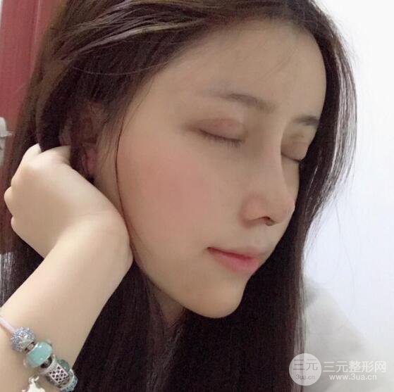 膨体隆鼻和双眼皮一起做的果怎么样？