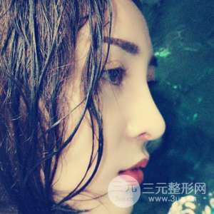 进口假体+肋软骨垫鼻尖三个月果恢复对比图