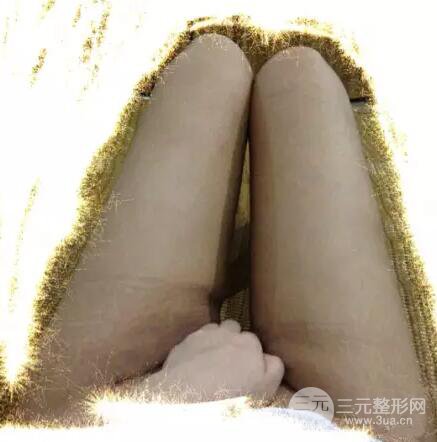 腿部吸脂亲身经历