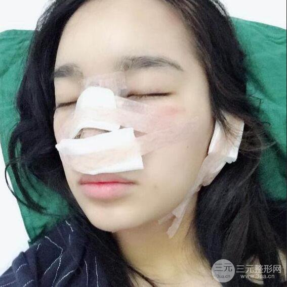 隆鼻整形术前术后对比照曝光，附经验分享及心得体会