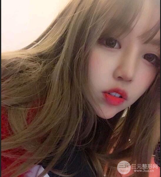 苏州芘丽芙华美孙培灵全切双眼皮真人恢复图曝光