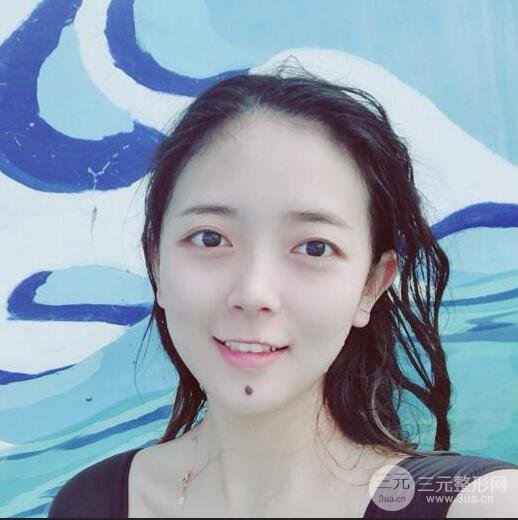 扬州艾菲斯黄婵双眼皮多项整形整形果真人反馈