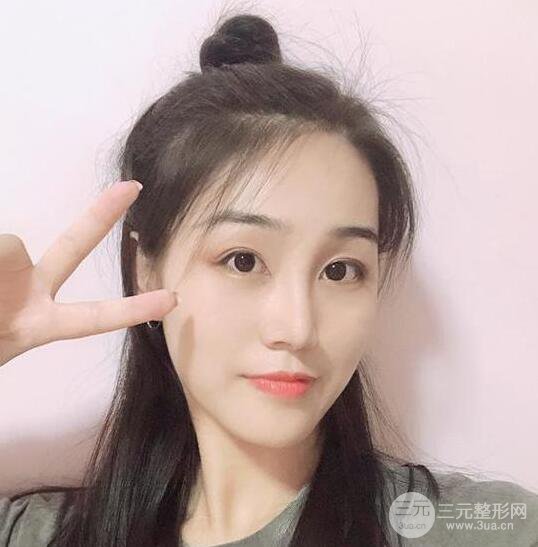 东莞宝格丽医疗美容韦文奇隆鼻整形60天恢复图片