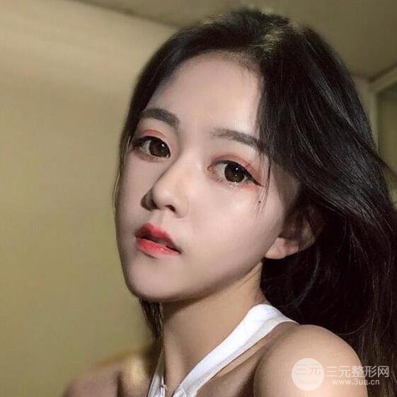 泉州亿星医疗美容闵英俊切开双眼皮果对比