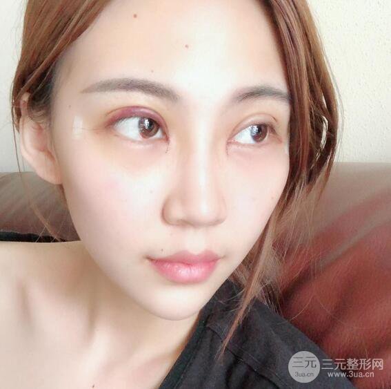 割双眼皮两个月是啥样，妹子公开恢复记录