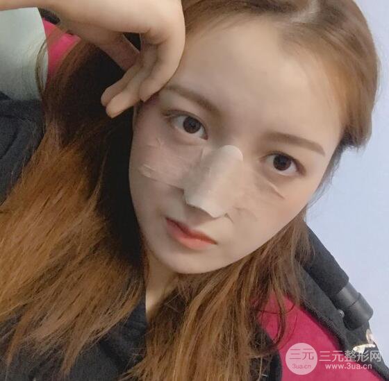 隆鼻整形多久恢复自然，模特公布隆鼻整形恢复记录附照片