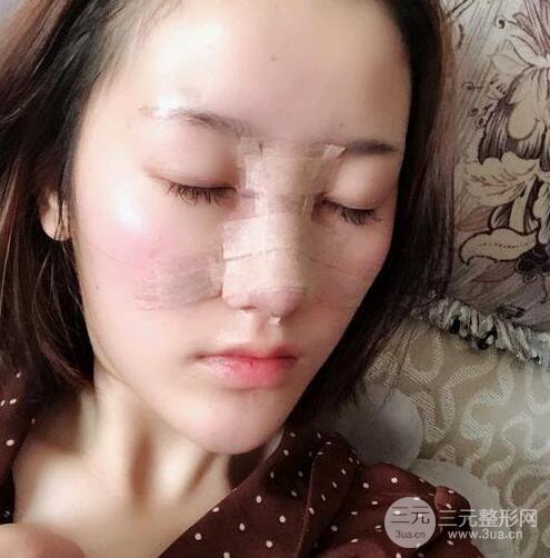 膨体隆鼻三十天恢复记录，术前术后对比图片曝光