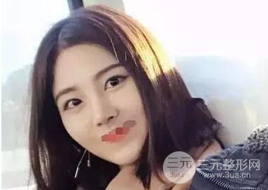 综合隆鼻前后对比照片案例