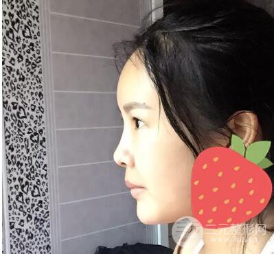 我的自体脂肪面部填充日记