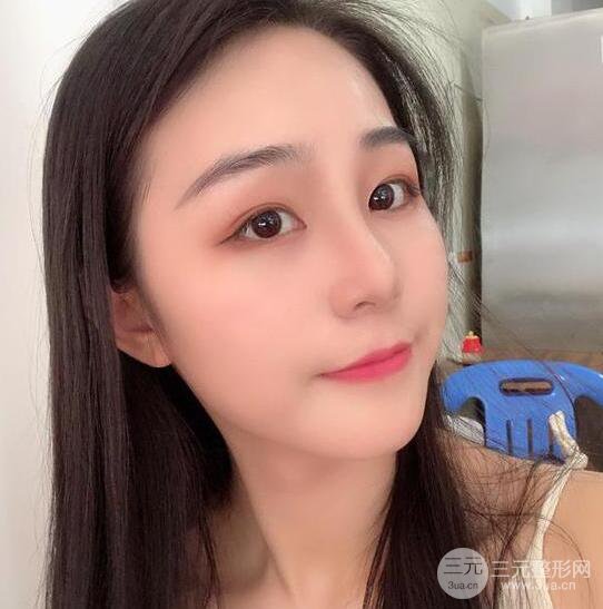 东莞宝格丽医疗美容韦文奇隆鼻整形60天恢复图片