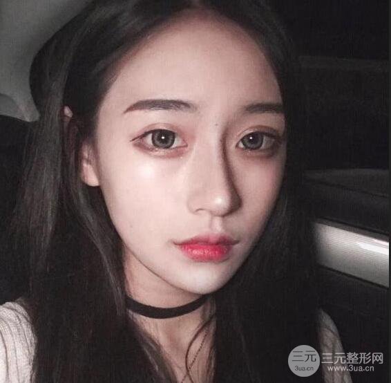 河南中医药大学第(一)附属医院赵绛波削下颌角恢复对比图