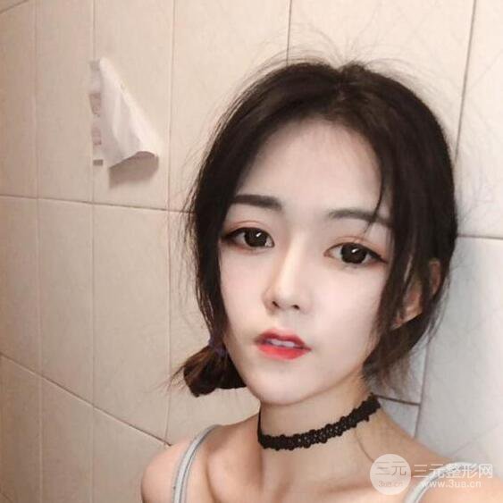 泉州亿星医疗美容闵英俊切开双眼皮果对比