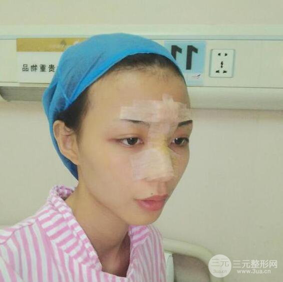 银川崔大夫博士丽朱杰硅胶隆鼻恢复图，轻松get精致脸