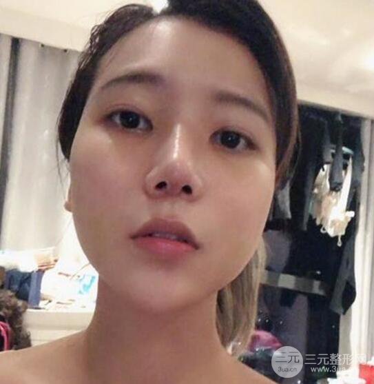 扬州艾菲斯医疗美容张健隆鼻整形恢复记录