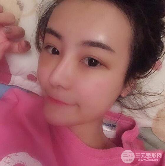 做了自体脂肪填充全脸，别人都以为我老公较为有钱