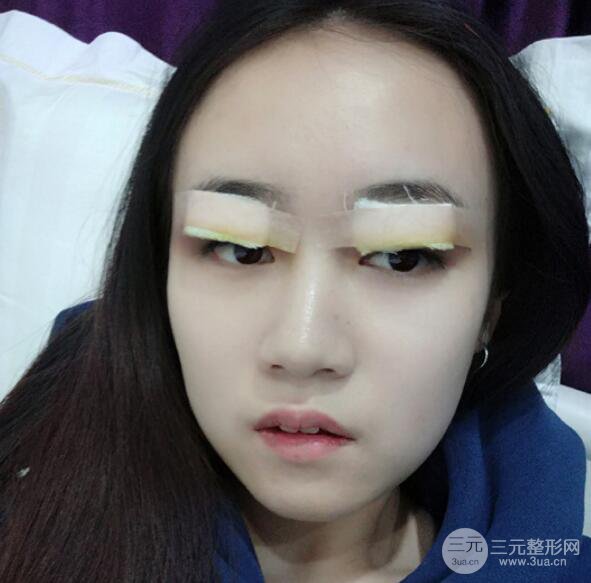 双眼皮7mm一年后照片