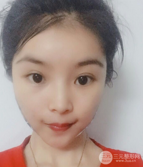 埋埋蛋白线.提升恢复图，原来小V脸不一定要磨骨