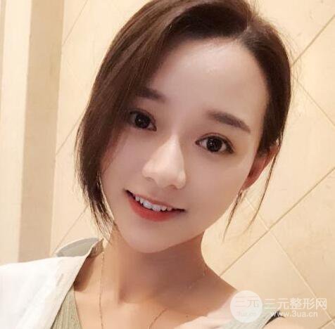 自体脂肪全脸填充三个月恢复图，真实案例分享