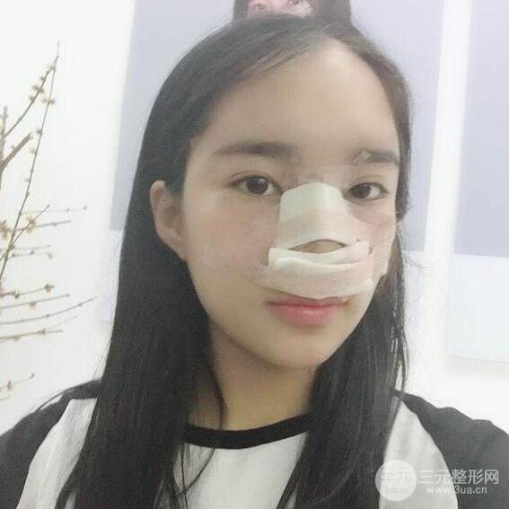 隆鼻整形术前术后对比照曝光，附经验分享及心得体会