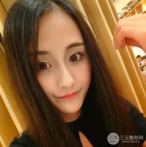 威高梨花医疗美容金成镐全切双眼皮+开眼角术后恢复记录