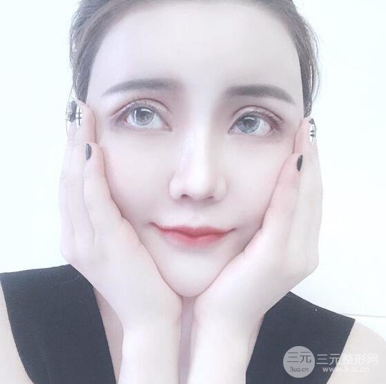 原来我和baby的距离只差一个网红套餐，“双眼皮+自体脂肪填充+丰唇”术后真人反馈