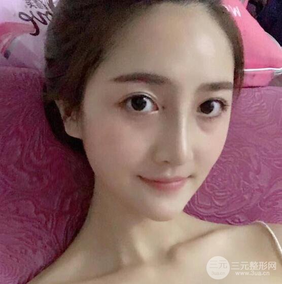 自体脂肪填充面部恢复记录，年轻十岁不是梦