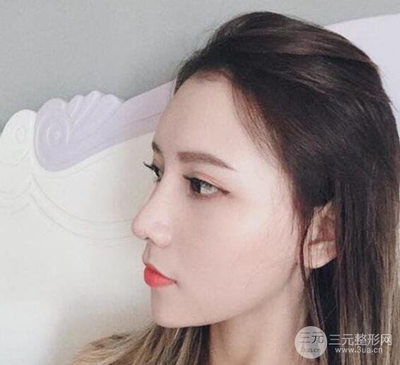 隆鼻整形手术三个月后真人果图