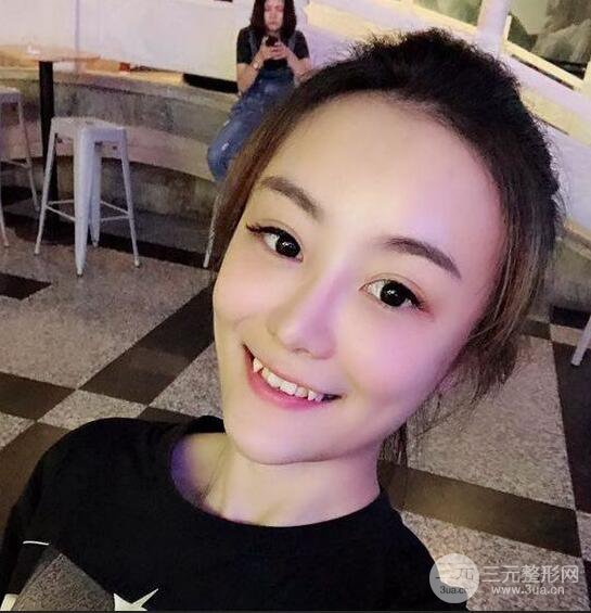 做了自体脂肪填充全脸，别人都以为我老公较为有钱