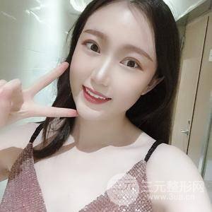 切开双眼皮+上睑下垂矫正术前术后果对比图