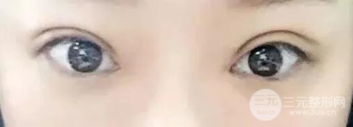 双眼皮手术后恢复期记录
