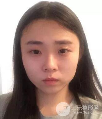 脂肪填充图片对比照片