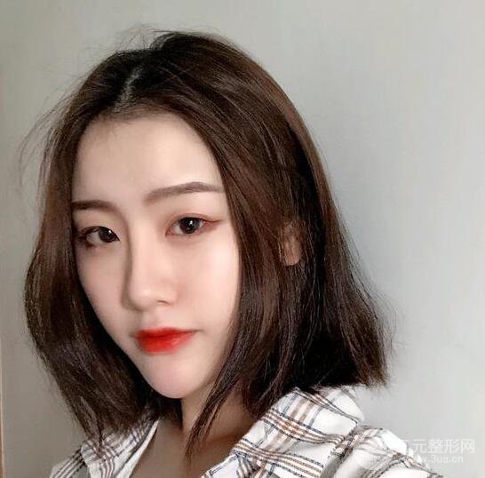 膨体隆鼻三十天恢复记录，术前术后对比图片曝光