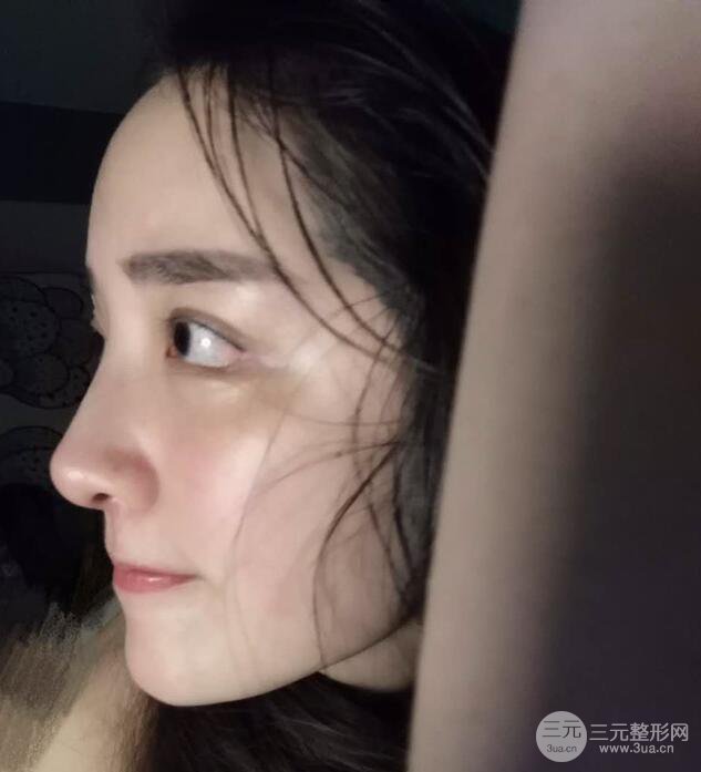 东莞宝格丽韦文奇隆鼻整形果图分享，对比曝光