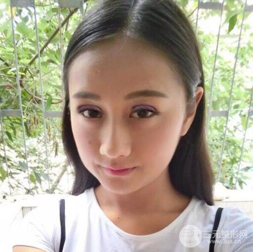 威高梨花医疗美容金成镐全切双眼皮+开眼角术后恢复记录