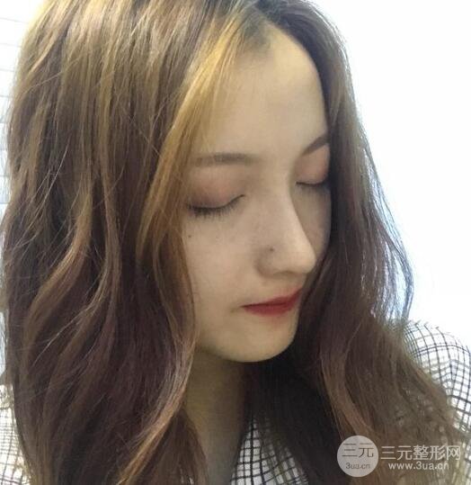 隆鼻整形多久恢复自然，模特公布隆鼻整形恢复记录附照片