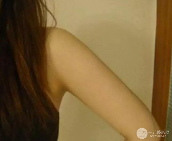 抽手臂脂肪的恢复过程