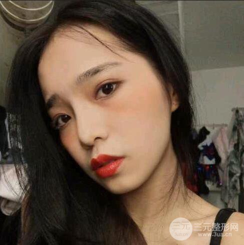 隆鼻整形术前术后对比照曝光，附经验分享及心得体会