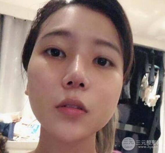 隆鼻整形手术三个月后真人果图