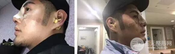 硅胶隆鼻一至7天恢复图