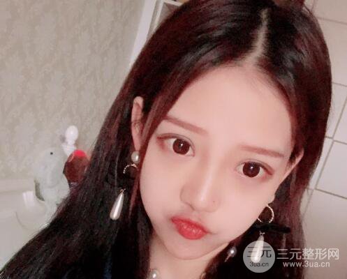 割双眼皮多久会恢复