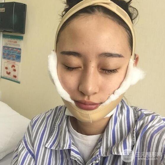 河南中医药大学第(一)附属医院赵绛波削下颌角恢复对比图