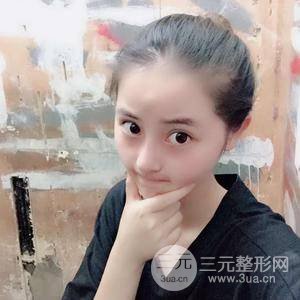 网红鼻整形三十天恢复记录