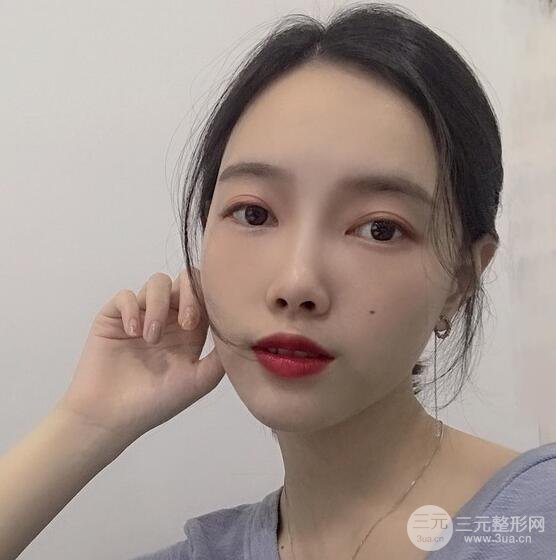 上海华美李健自体脂肪详细部填充果图，少女脸经久不衰的秘密在这里